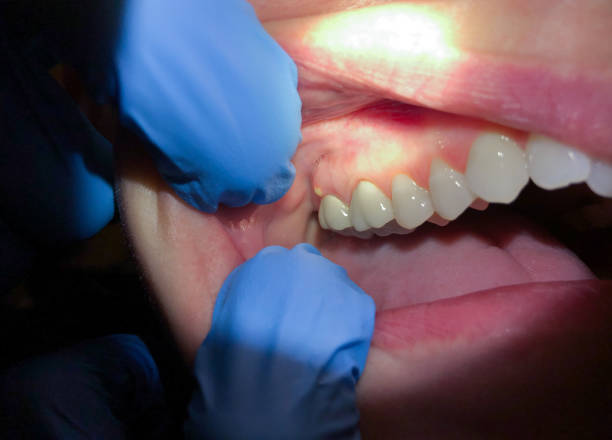 Best Emergency Tooth Extraction in St Augustine, FL